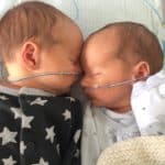 twins with nasal feeding tubes